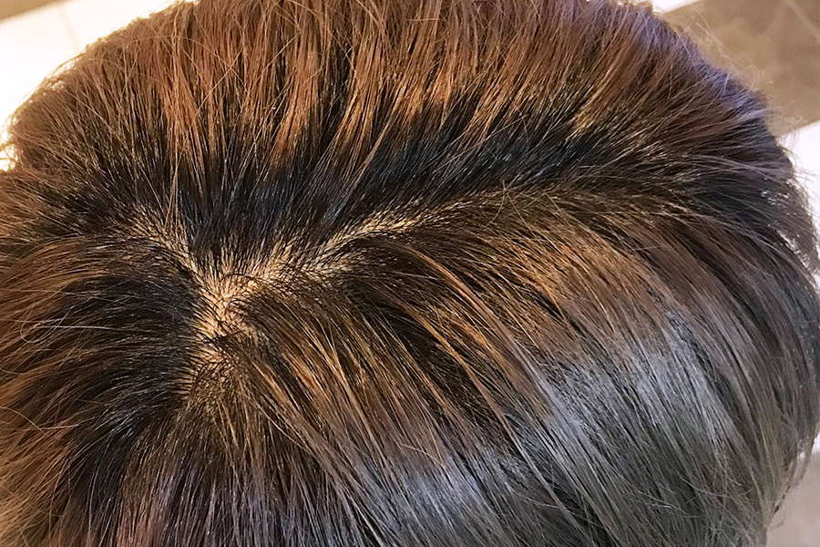 頭頂部根本2㎝
